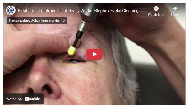 blephex video screenshot 30 percent 2025 10 19 190214