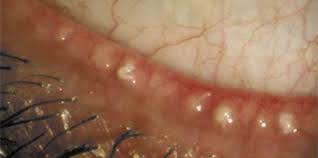 capped glands images