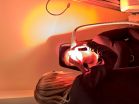 pinder ipl treatmentsmall